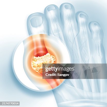 Gout Gout
