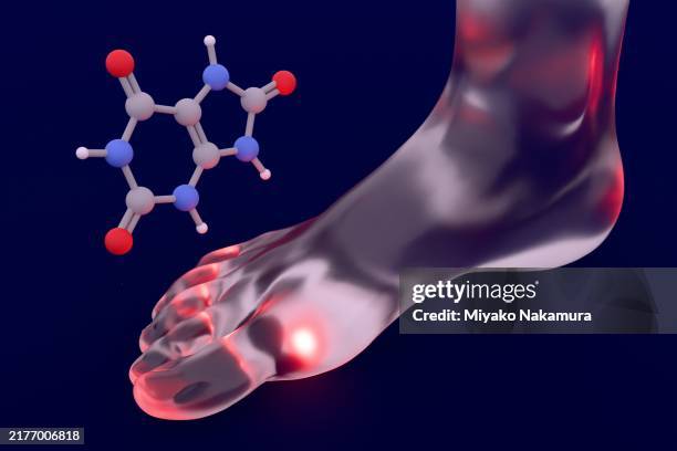 dolore gottoso alla gamba. struttura dell'acido urico - gotta foto e immagini stock