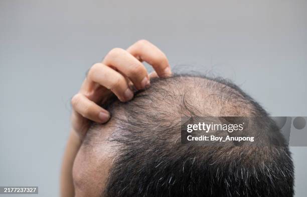 cropped shot view of baldness asian man having itching problem on his scalp becaused of dandruff. - balding stock pictures, royalty-free photos & images