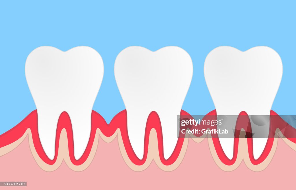 Denti sani impostati. Odontoiatria. Denti nelle gengive. Trattamento dentale in una clinica odontoiatrica.