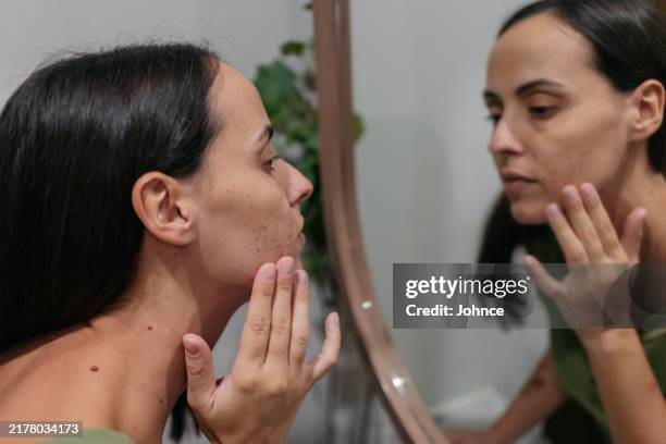 femme appliquant des soins de la peau cicatrices d’acné - hormone photos et images de collection