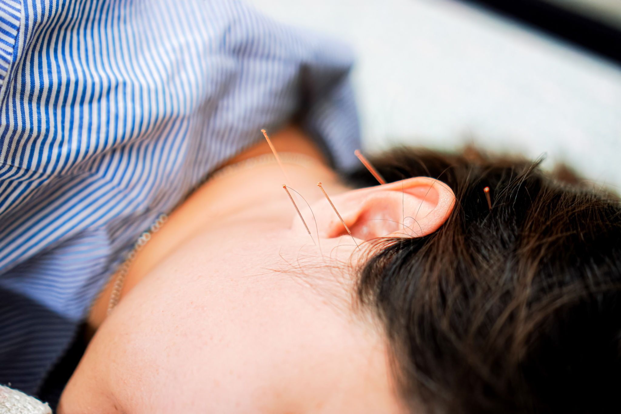 Close-up image of acupuncture around the ear for the treatment of tinnitus in Traditional Chinese Medicine, Chiang Mai, Thailand. Close-up image of acupuncture around the ear for the treatment of tinnitus in Traditional Chinese Medicine, Chiang Mai, Thailand.