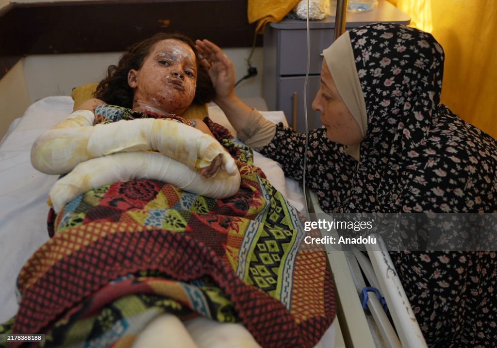 Palestinian girl, whose face and body were burned in the Israeli attack, receives limited treatment in Deir al-Balah