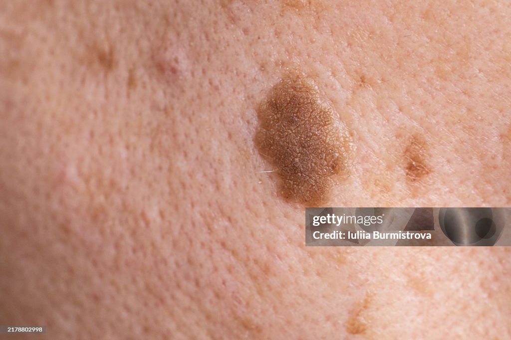 Close-up of Seborrheic Keratosis on an Adult Woman's Face