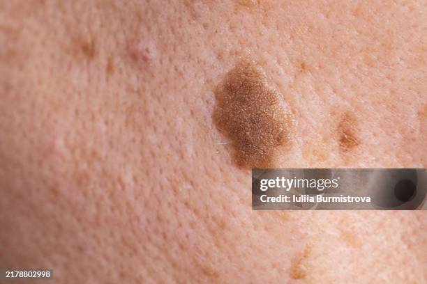 close-up of seborrheic keratosis on an adult woman's face - verrugas plantar imagens e fotografias de stock