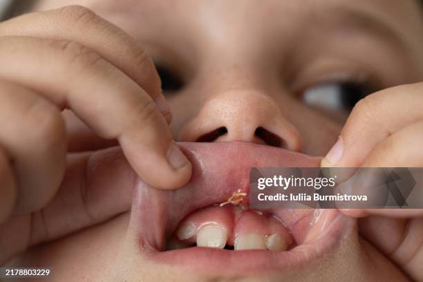 child displays stitches after upper lip frenectomy for bite correction (frenulum labii superioris) - schnittwunde stock-fotos und bilder