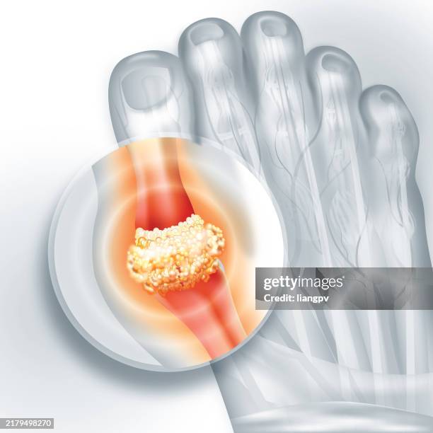 illustrazioni stock, clip art, cartoni animati e icone di tendenza di gout - gotta