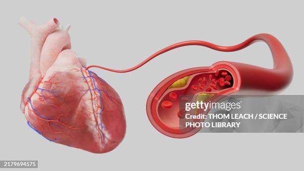 coronary artery disease, illustration - atherosklerose stock-grafiken, -clipart, -cartoons und -symbole