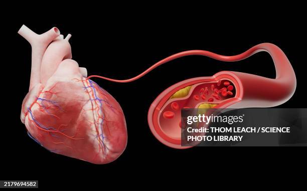 coronary artery disease, illustration - atherosklerose stock-grafiken, -clipart, -cartoons und -symbole