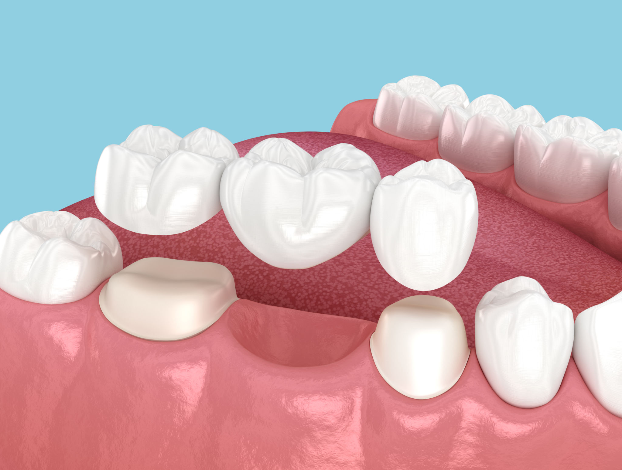 dental bridge