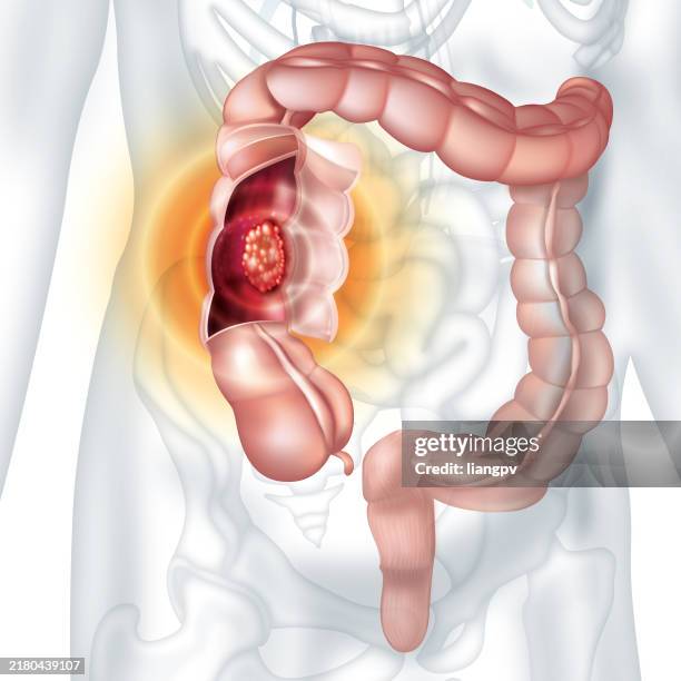 ilustraciones, imágenes clip art, dibujos animados e iconos de stock de cáncer de colon - colon