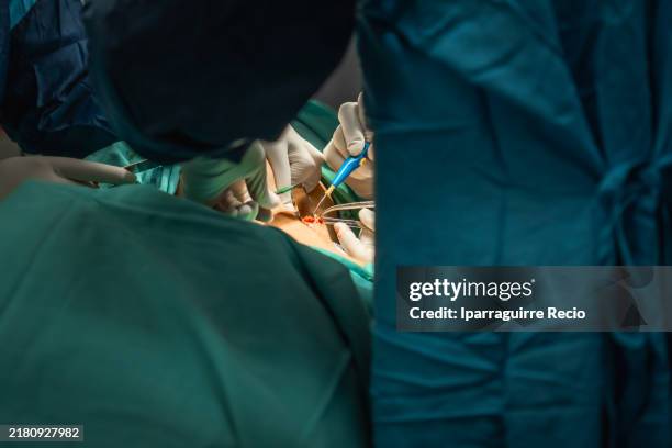 Sentinel Node Excision 151 Sentinel Node Stock Photos, High-Res Pictures, and Images - Getty ...