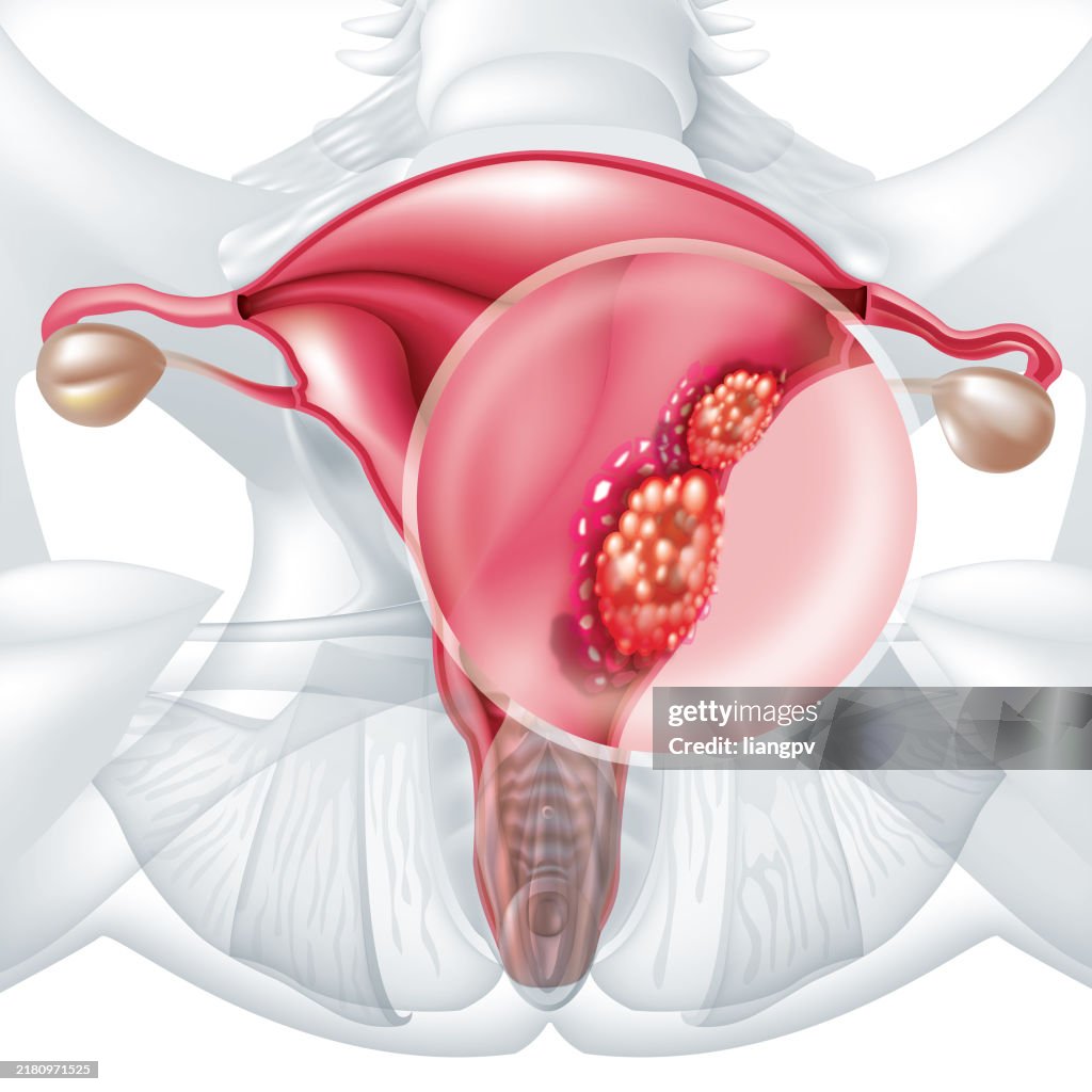 Cervical cancer