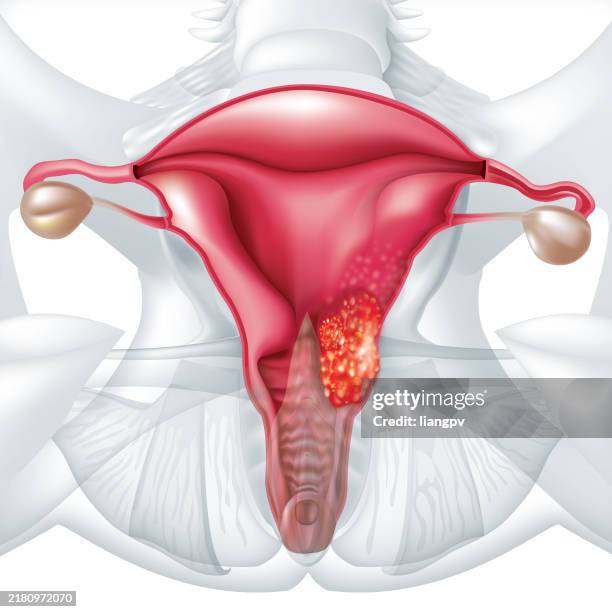 ilustraciones, imágenes clip art, dibujos animados e iconos de stock de cáncer cervical - útero humano