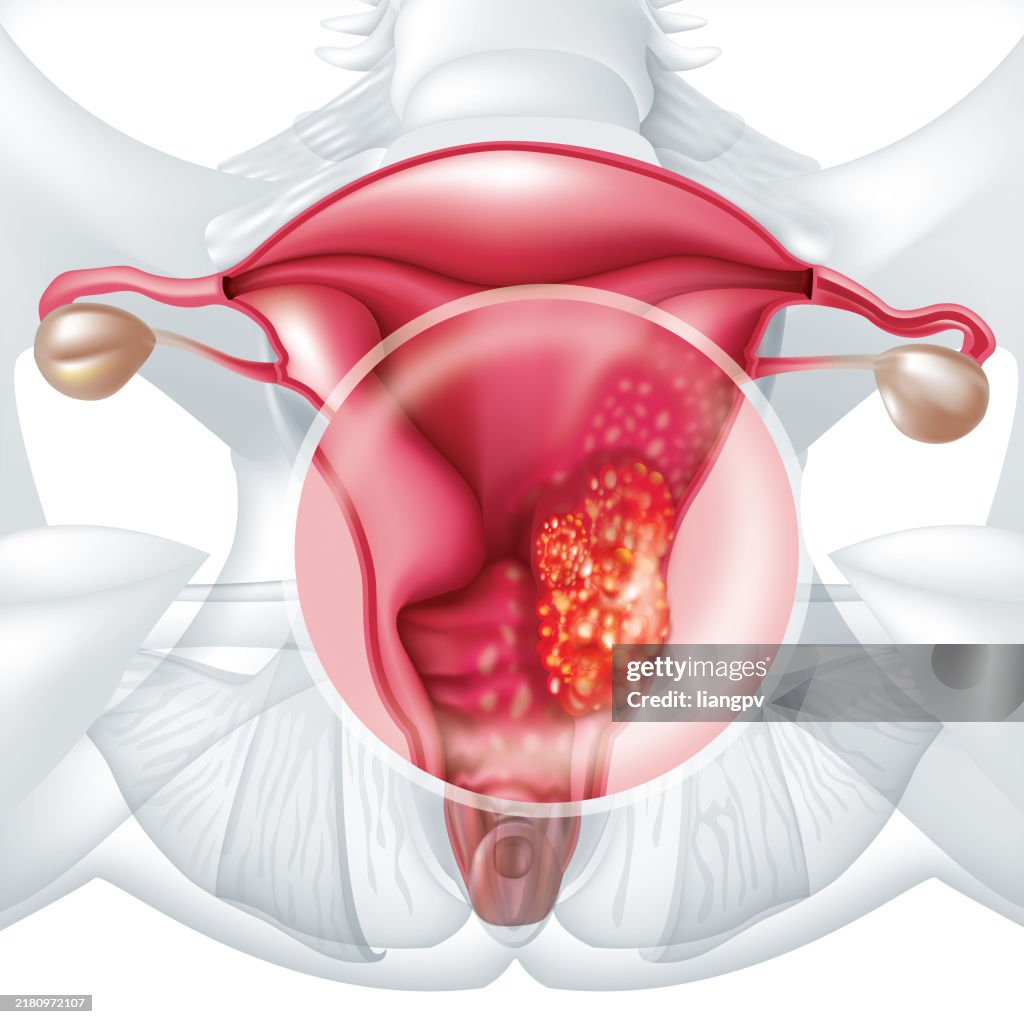 Cervical cancer