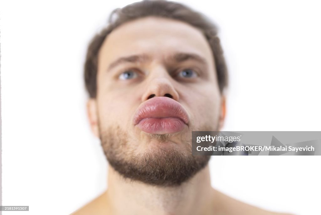 Allergic reaction on the lip angioedema in a man, consequences of hyaluronic acid injections