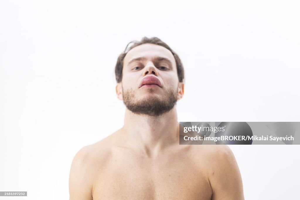 Allergic reaction on the lip angioedema in a man, consequences of hyaluronic acid injections