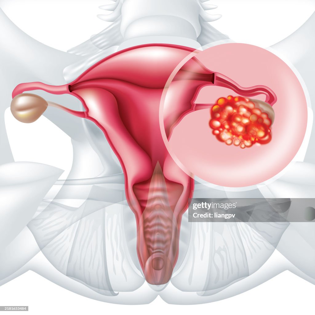 Cervical Cancer