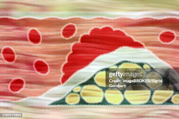 arteriosclerosis is a common vascular disease in which the arteries become narrowed and hardened by deposits such as fats - narrow stock illustrations