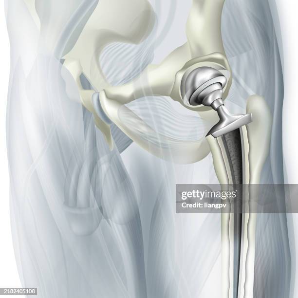 hip arthroplasty - hip replacement stock illustrations