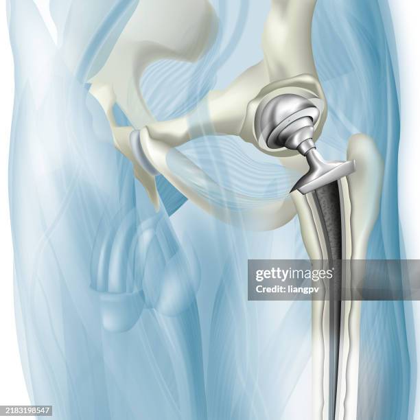 hip arthroplasty - hip replacement stock illustrations