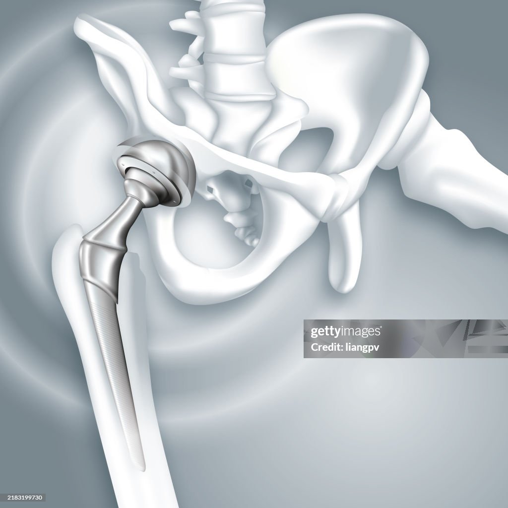 Hip arthroplasty