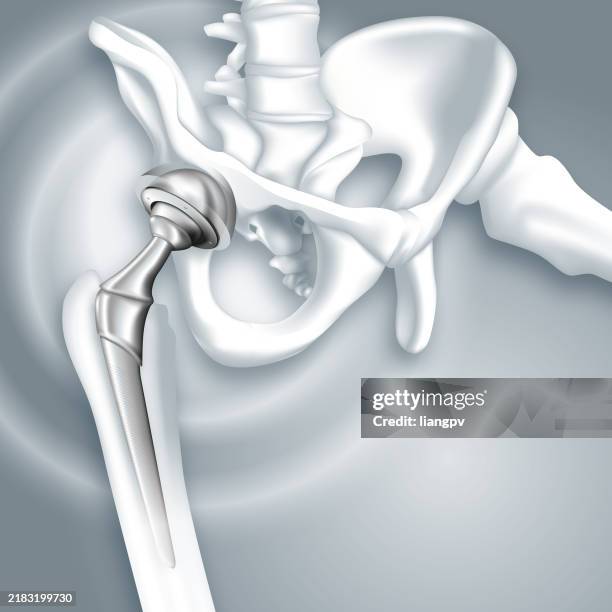 hip arthroplasty - hip replacement stock illustrations