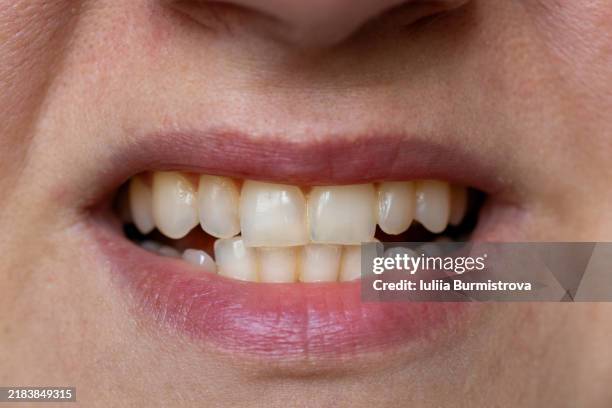 woman's yellowed teeth before cleaning - yellow stock pictures, royalty-free photos & images