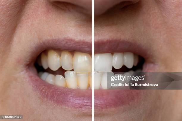 teeth whitening: before and after plaque removal - sbiancamento dentale foto e immagini stock