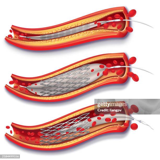 angioplasty and stent placement - cardiovascular system stock illustrations