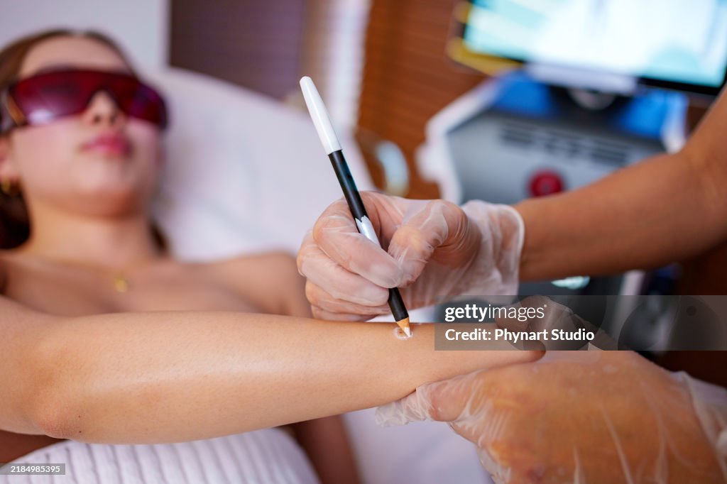 Präzise Hautmarkierung für die Laserbehandlung