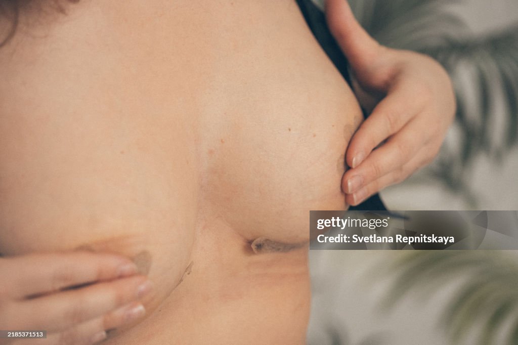 Woman patient after plastic surgery examines the stitches of medical mammoplasty, breast augmentation
