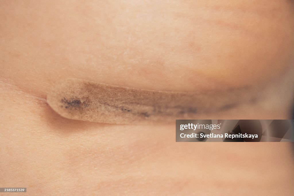Suture on the chest close-up after plastic surgery, mammoplasty, breast augmentation