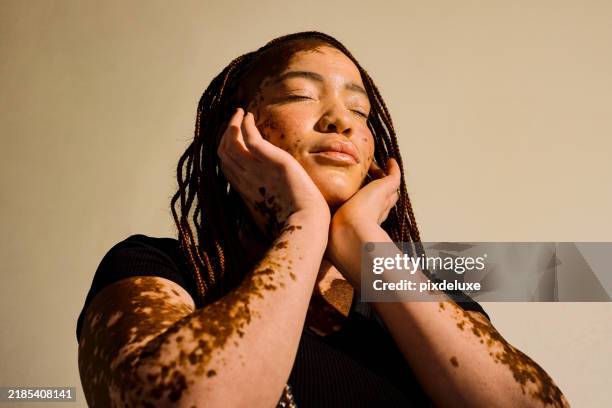 frau der generation z mit vitiligo, die ihre einzigartige haut umarmt. beauty- und wellnesskonzept. - vitiligo stock-fotos und bilder