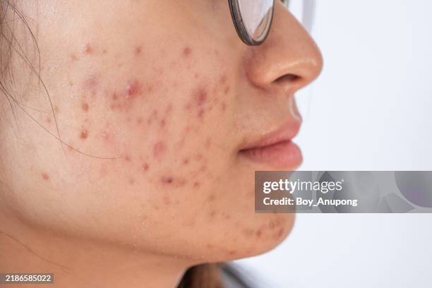 cropped shot of asian woman having problems of acne inflamed on her cheek. - pimple stock pictures, royalty-free photos & images
