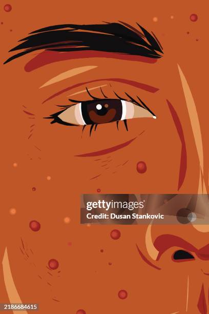 ilustraciones, imágenes clip art, dibujos animados e iconos de stock de el acné es uno de los problemas de la juventud - acné