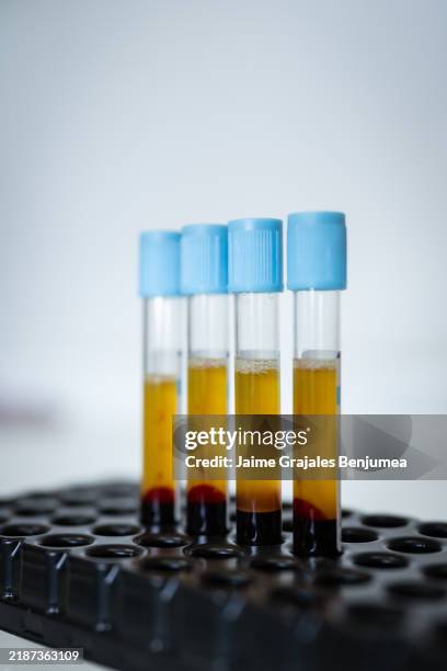 platelet-rich plasma (prp) in test tubes for dermapen treatment rejuvenating skin - platelet rich plasma stockfoto's en -beelden
