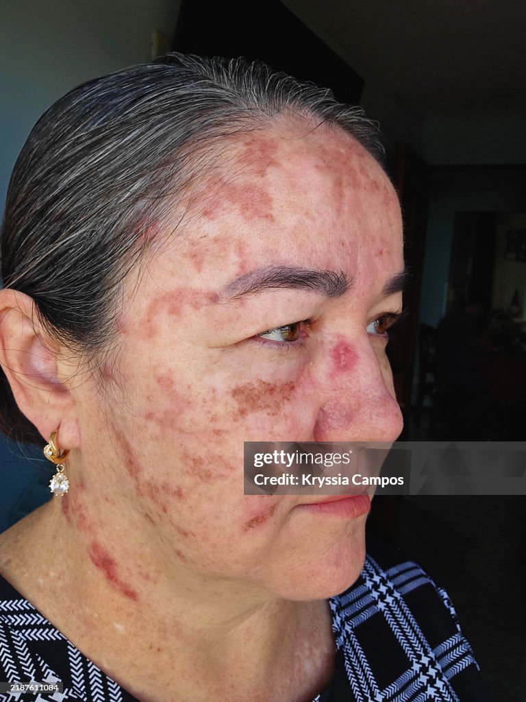 Cryotherapy Treatment for Skin Cancer Prevention