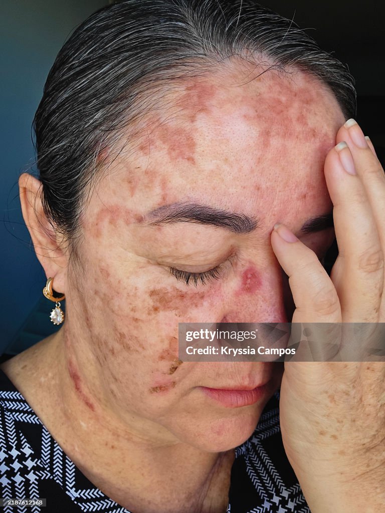 Cryotherapy Treatment for Skin Cancer Prevention