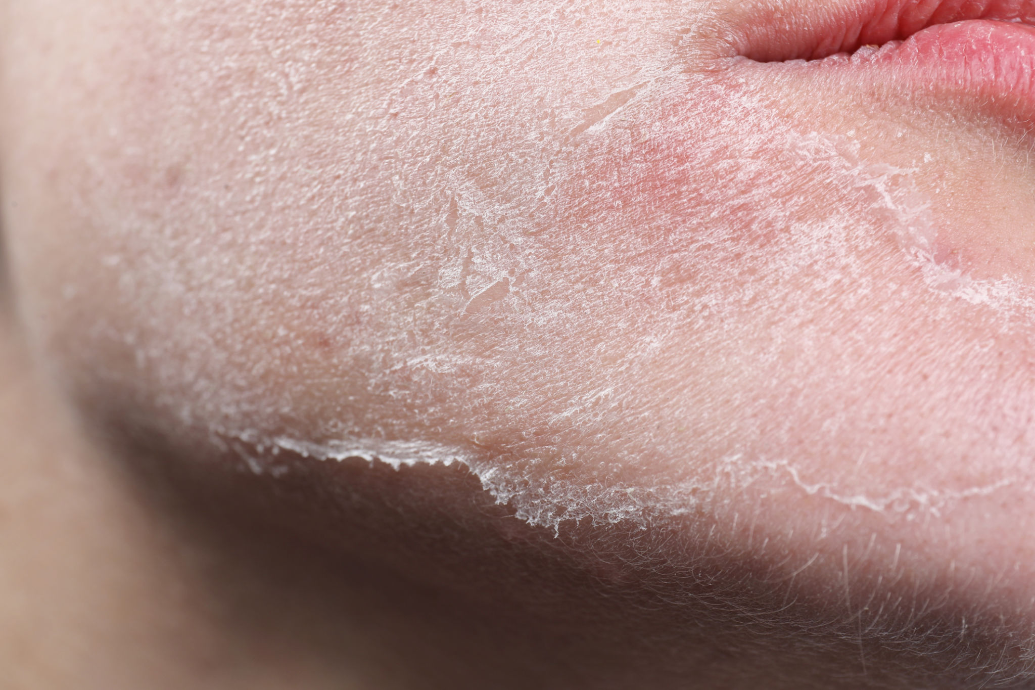dry skin