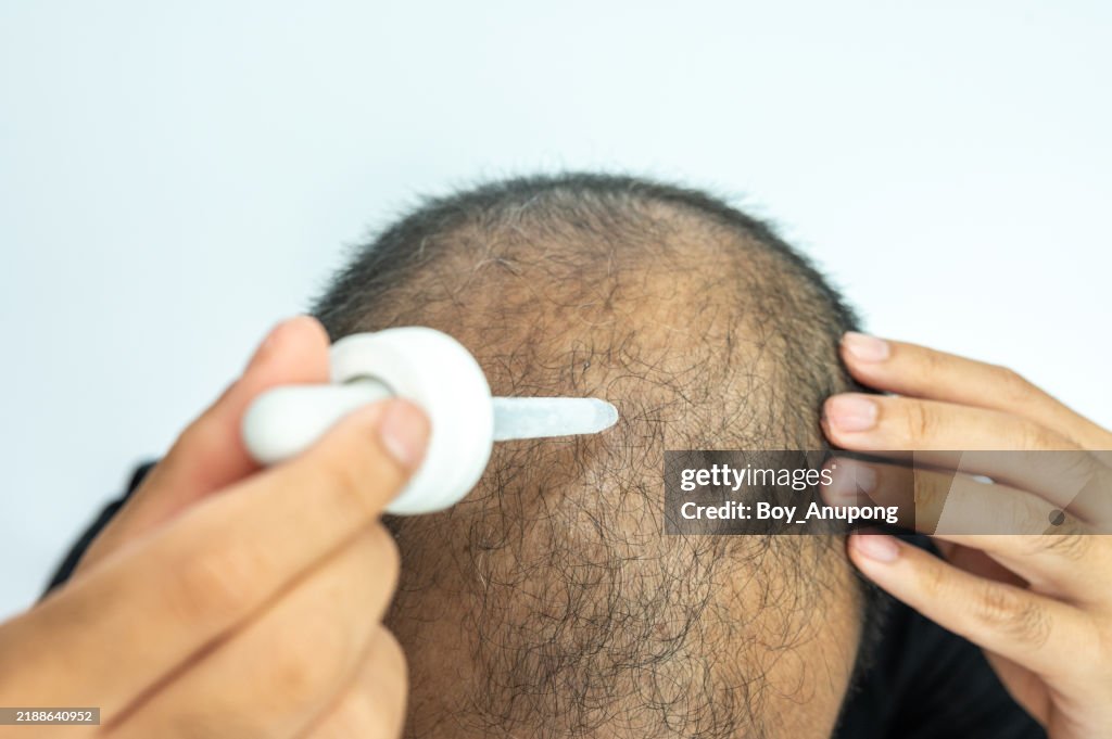 Cropped shot view of Asian baldness man using a dropper for dropping Minoxidil to his scalp.