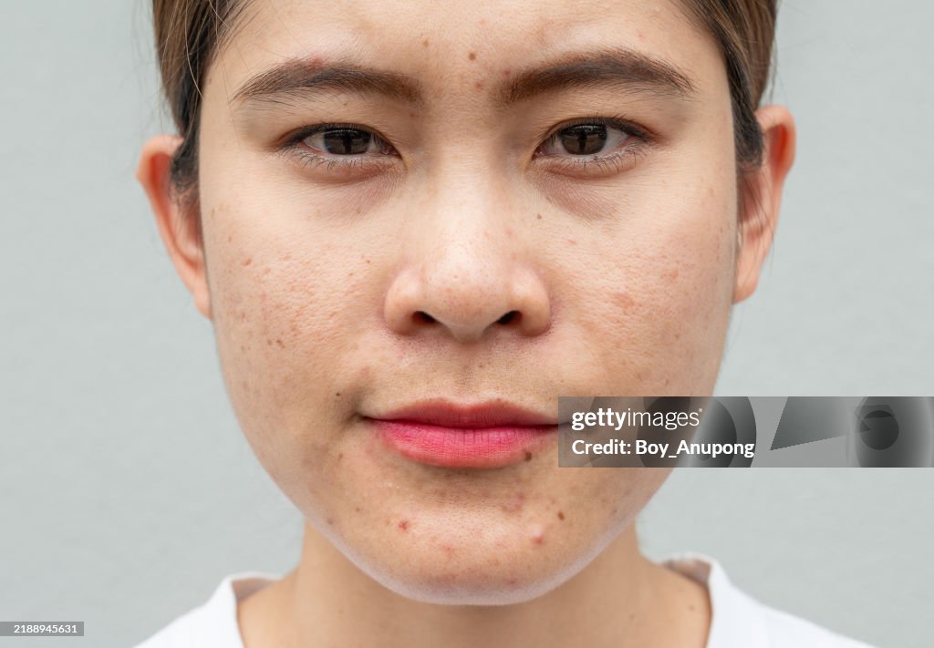Portrait of unhappiness Asian woman with acne, wrinkles and freckles occur on her skin depend on aging.