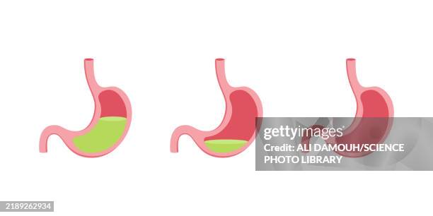 achlorhydria, illustration - gastric acid stock illustrations