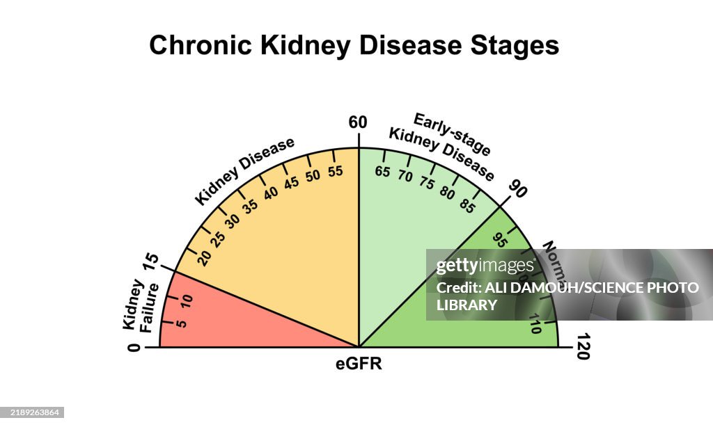 Chronic Kidney Disease Stages Illustration HighRes Vector Graphic