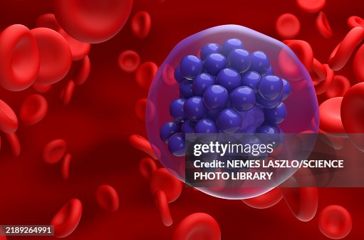Diffuse large B-cell lymphoma, illustration Diffuse large B-cell lymphoma, illustration