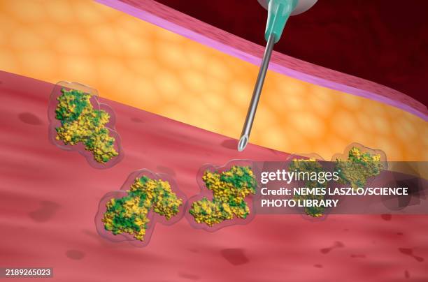 Botox Injection Illustration High-Res Vector Graphic - Getty Images