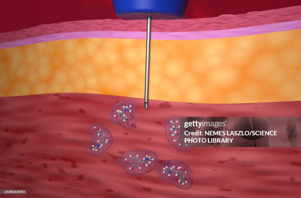 Adrenaline injection, illustration