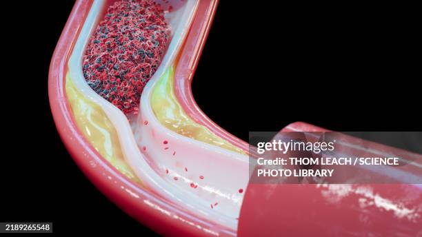 atherosclerosis and blood clot in human blood vessel, illustration - atherosklerose stock-grafiken, -clipart, -cartoons und -symbole