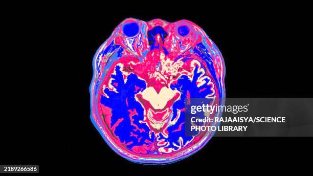 healthy brain, mri scan - magnetresonanztomographie stock-fotos und bilder