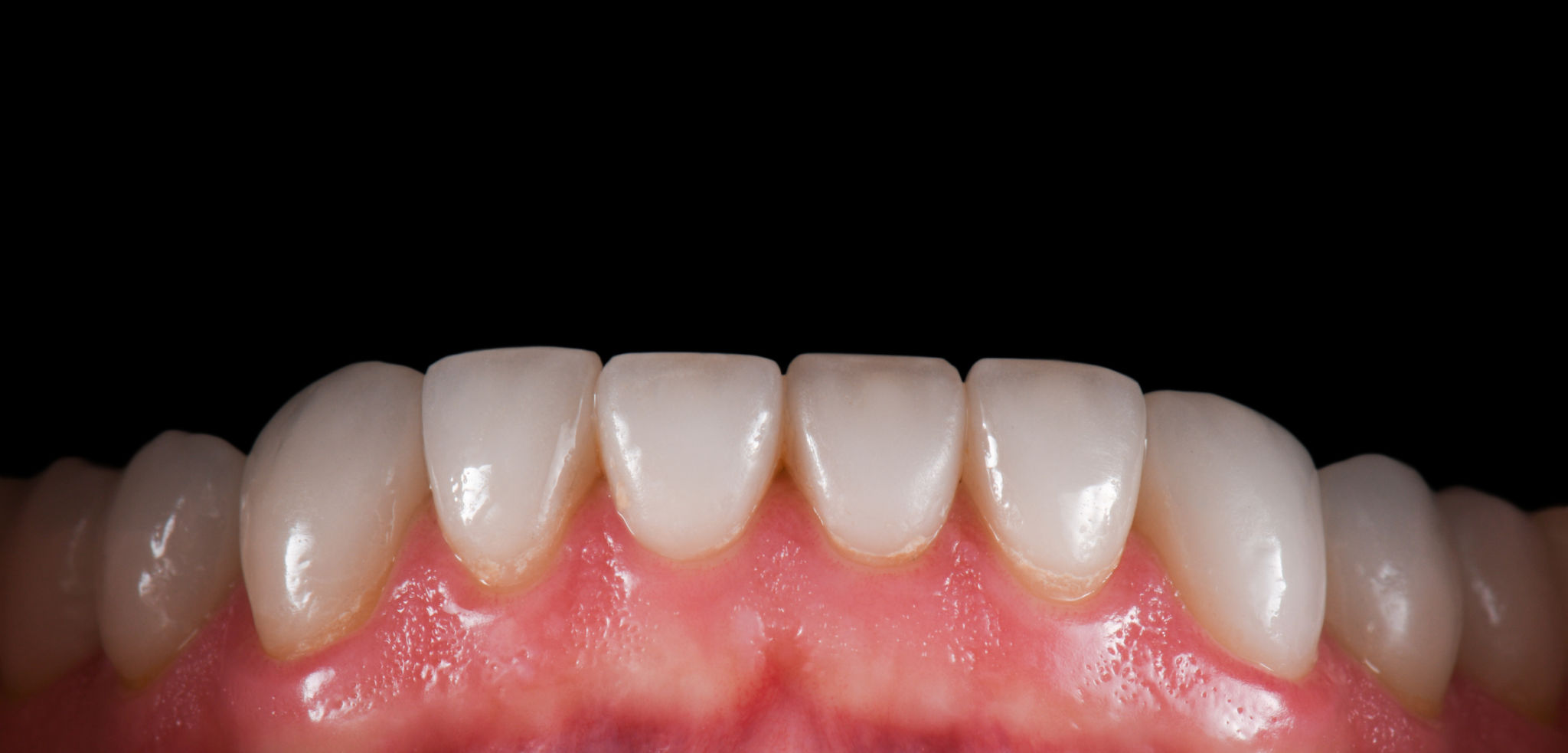 carillas dentales